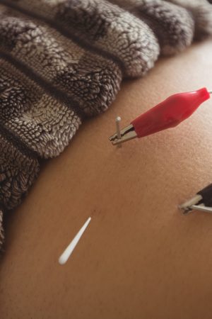 Close-up of patient getting electro dry needling on his waist